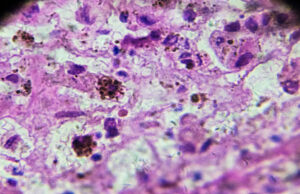 Uno de cada siete pacientes con melanoma tienen predisposición genética