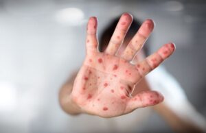 RD se suma a alerta en viruela