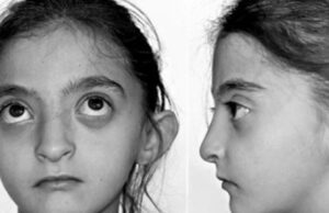 El Día Internacional del Síndrome de Wolf-Hirschhorn